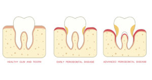 Keep your gums healthy