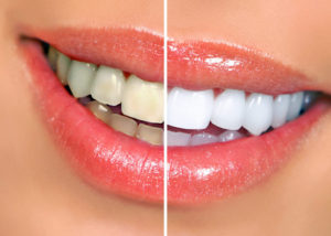 whiter smile in Highlands Ranch