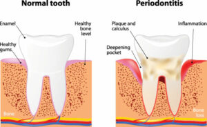 Periodontitis is the most common cause of tooth loss in adults