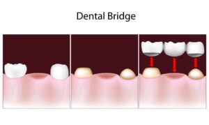 Dental crowns and bridges results at HR Family Dental in Highlands Ranch, CO