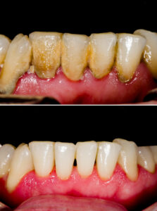 Oral hygiene issue solved at HR Family Dental Highlands Ranch