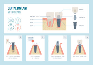 The entire dental implant process, typically spanning 3-12 months, is designed for precision and comfort, with Dr. Lunn ensuring a smooth experience from start to finish.