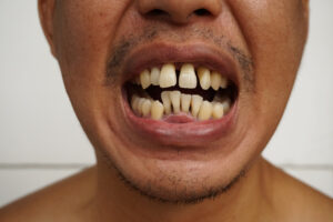 Missing teeth in highlands ranch