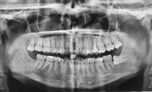 Comprehensive Full Mouth Reconstruction in Highlands Ranch, CO