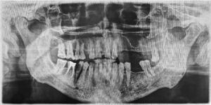 Restore your smile with dental crowns and bridges in Highlands Ranch, CO. Dr. Lunn at HR Family Dental offers specialized, compassionate care