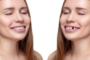 At HR Family Dental in Highlands Ranch colorado, Dr. Lunn uses cutting-edge technology to ensure precise, comfortable dental implant placement.
