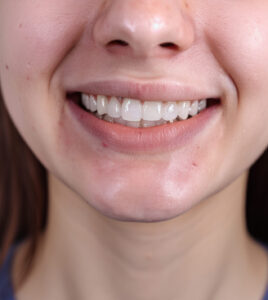 After Dental Reconstruction HR Family Dental Highlands Ranch