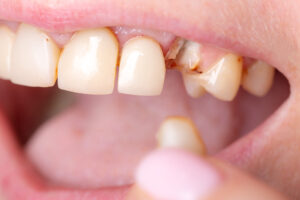 Replace Missing Teeth with Dental Implants in Highlands Ranch, CO at HR Family Dental