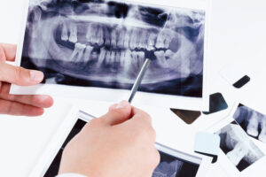 Comprehensive Full Mouth Reconstruction in Highlands Ranch, CO