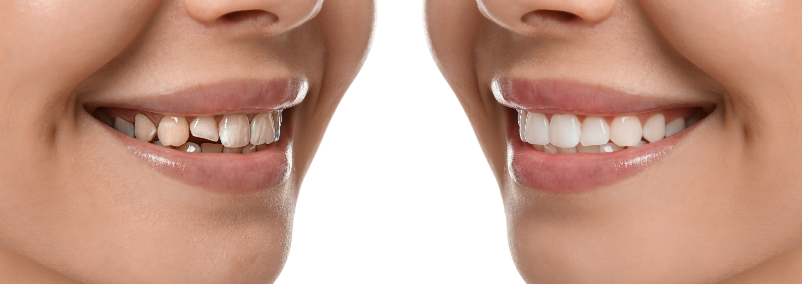 ultra‑thin veneers Highlands Ranch Colorado