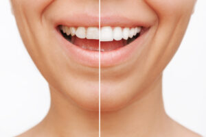 ultra‑thin veneers Highlands Ranch