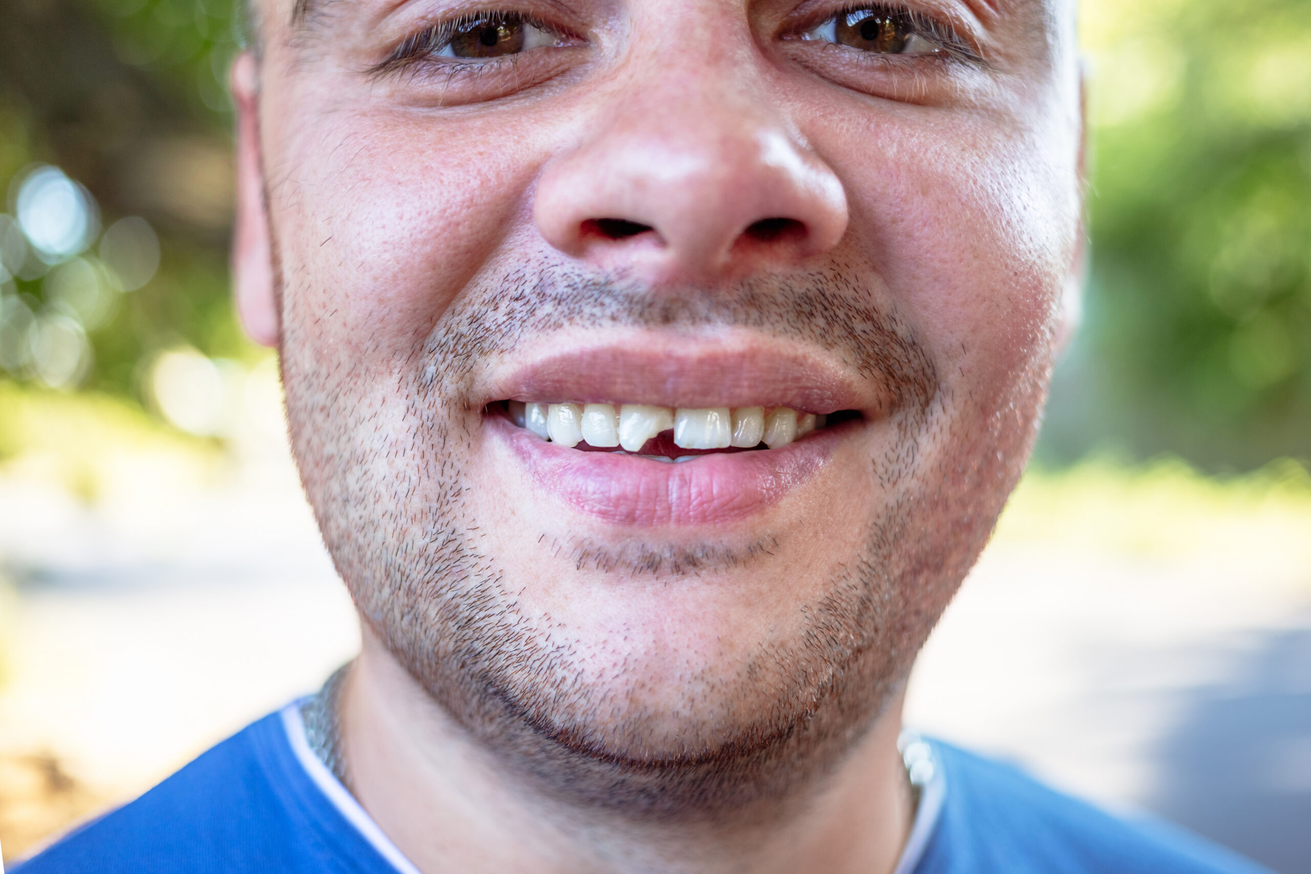 Chipped or Missing Teeth